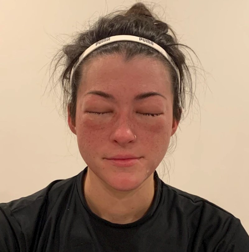 12. "Danas sam saznala da sam alergična na banane"