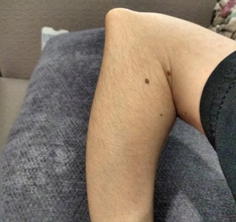 2. "Imam rijedak genetski poremećaj koji uzrokuje izrasline na kostima na različitim dijelovima tijela"