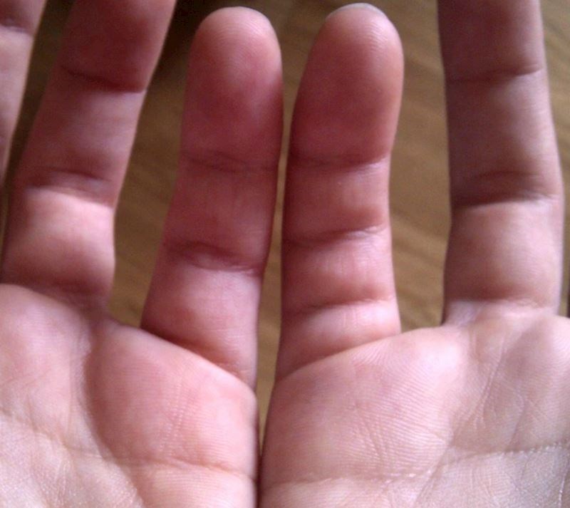 "Imam dodatne članke na malim prstima i samo na njima"