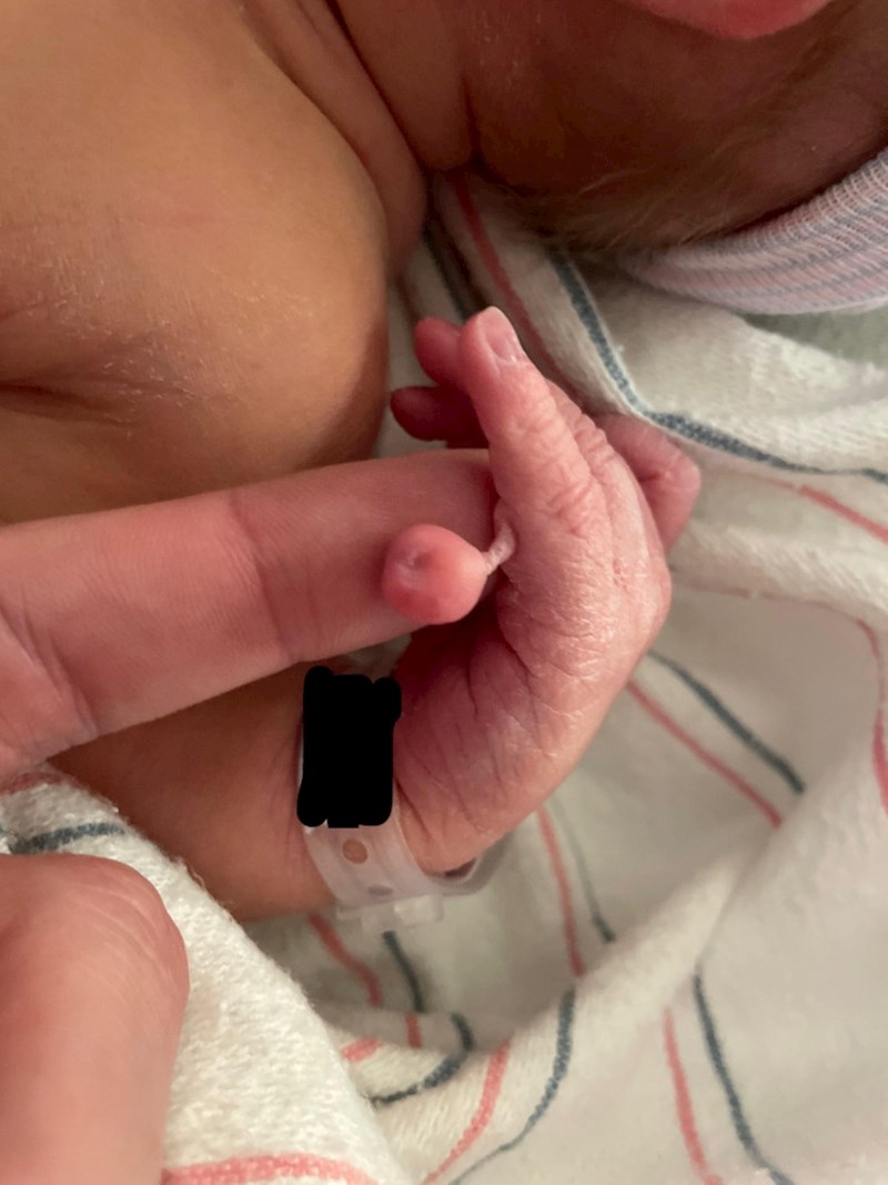 12. Beba se rodila s dodatnim prstićem koji se nije razvio