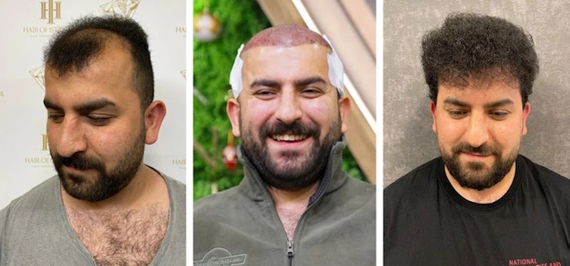 15. Drugi čovjek nakon presađivanja kose!