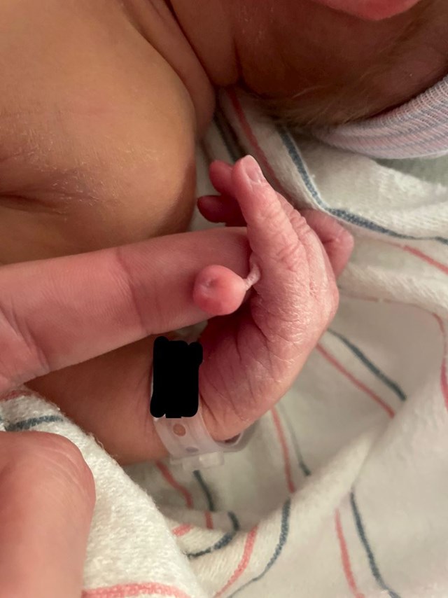 "Moja bebica se rodila s jednim prstićem više"