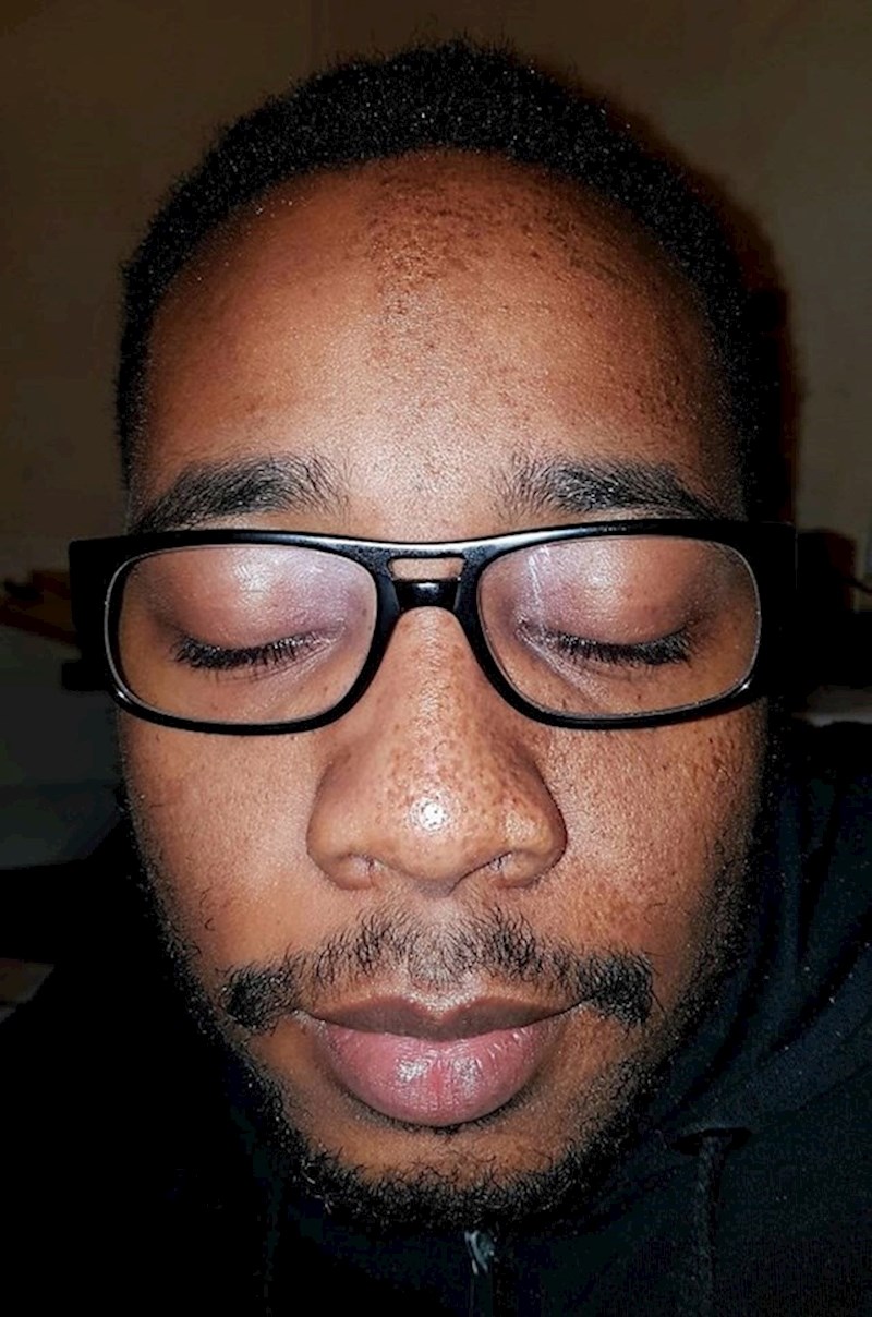 Ovaj čovjek ima pjegice na samo pola lica.