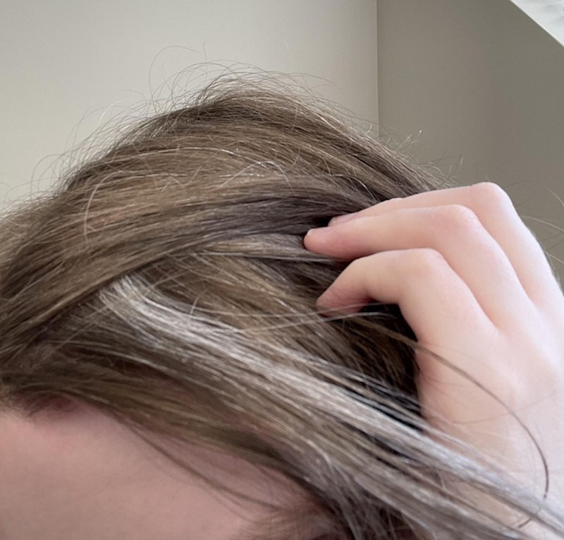 2. Ova djevojka ima 24 godine i već cijeli jedan bijeli pramen