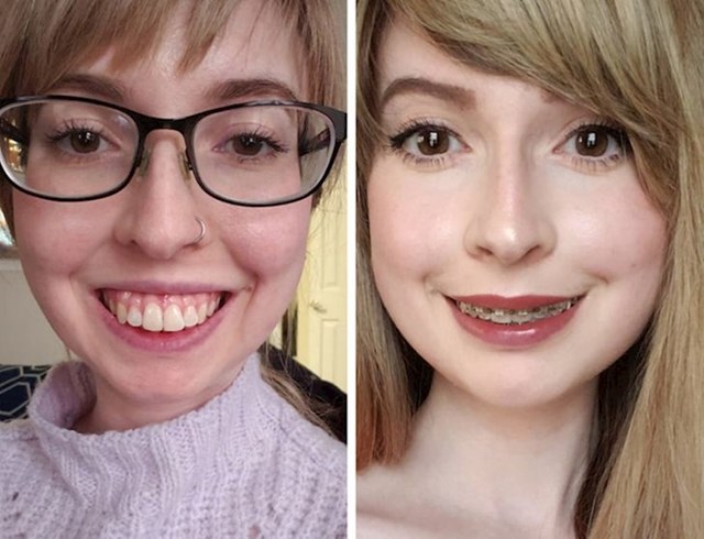 15. "Odlučila sam operirati gornju čeljust, kad gledam ove dvije fotografije ne vjerujem da je na njima ista osoba"