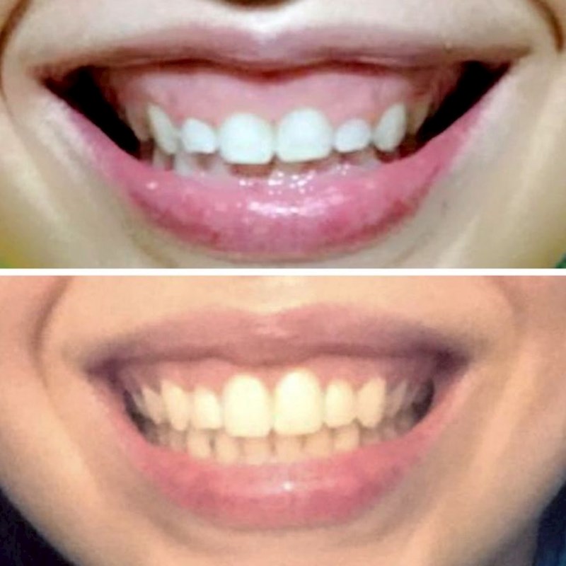 9. "Odlučila sam napraviti gornju i donju gingivektomiju. Fotografije su nastale u četiri mjeseca razlike. Sada se ne prestajem smijati"