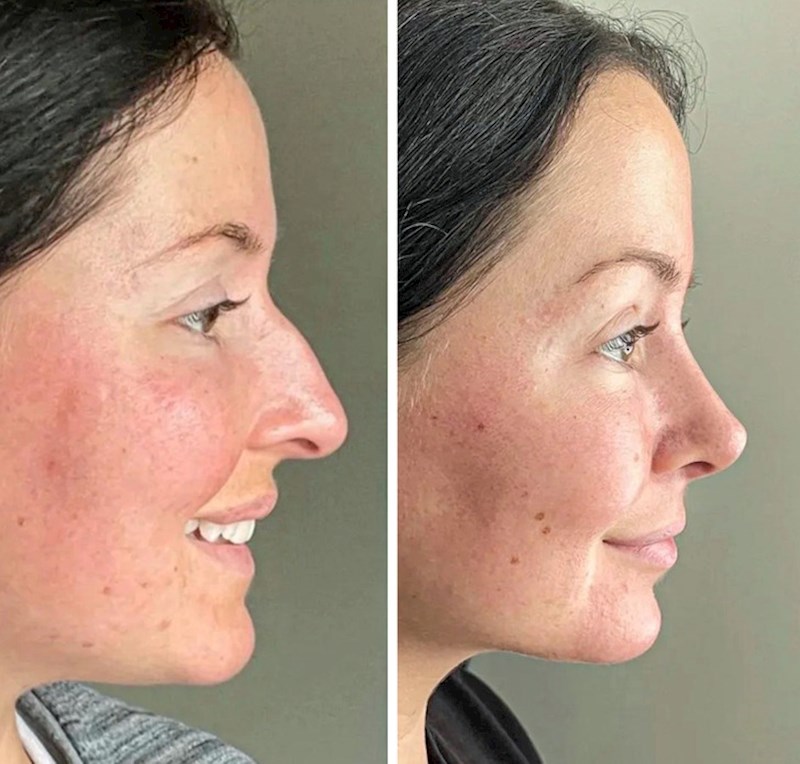 4. Operacija nosa i korekcija čeljusti, izgleda totalno drugačije!