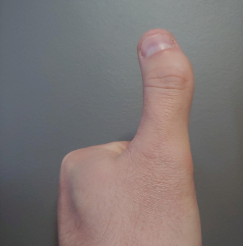 5. Ovaj muškarac se rodio sa savijenim palčevima