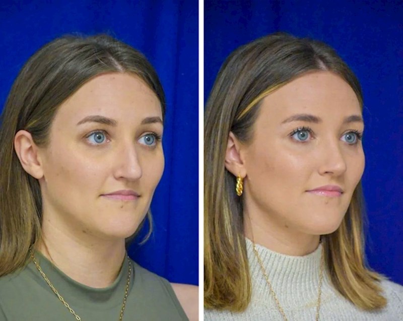 9. Ova žena je radila vježbe kako bi imala izraženiju čeljust