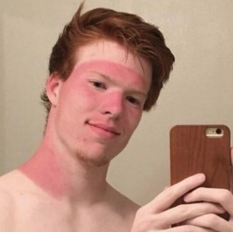 "Svi koji imaju narančastu kosu znaju da ljeto nije milostivo prema koži."