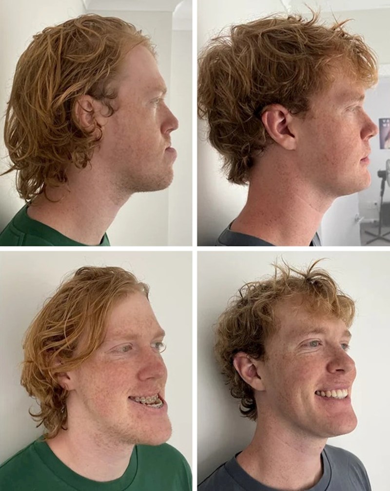 6. "Operacija čeljusti je bilo ono što mi je trebalo da promijenim život i postanem samouvjereniji"