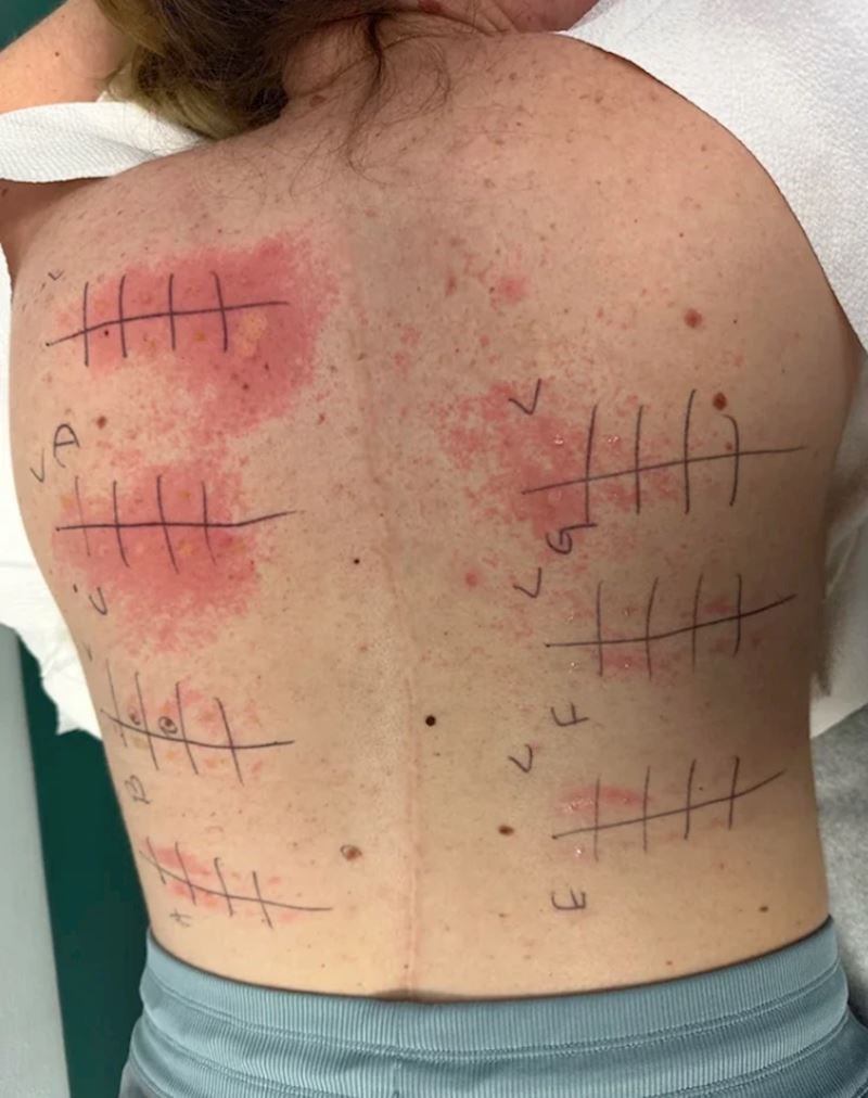 "Čini se da sam alergična na sve na što sam se testirala."