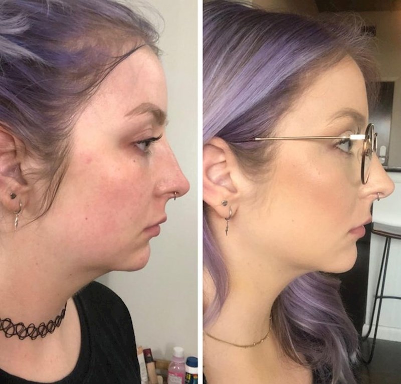 5. "Odlučila sam ukloniti svoju duplu bradu koje se nikako nisam mogla riješiti prirodnim putem. Rezultat je fantastičan!"