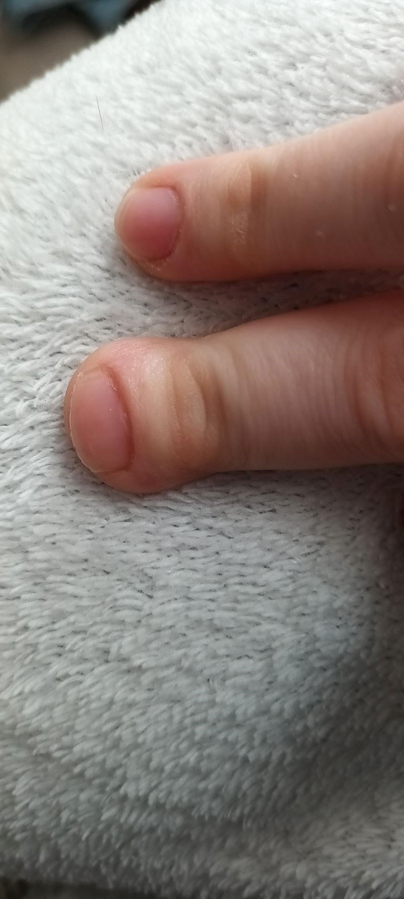 "Jedan prst mi je drugačijeg oblika od svih ostalih"