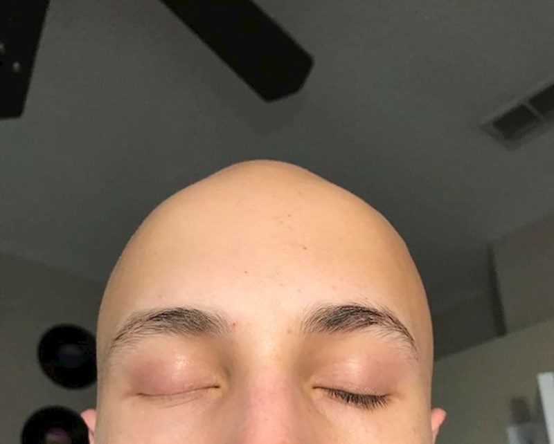 "Prirodno na jednoj strani nemam trepavice."