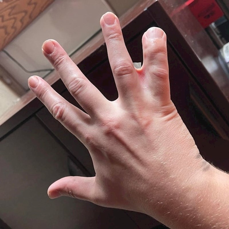 4. "Moj šef ima ovako spojene prste, izgleda kao da su mu spojena dva mala prsta"