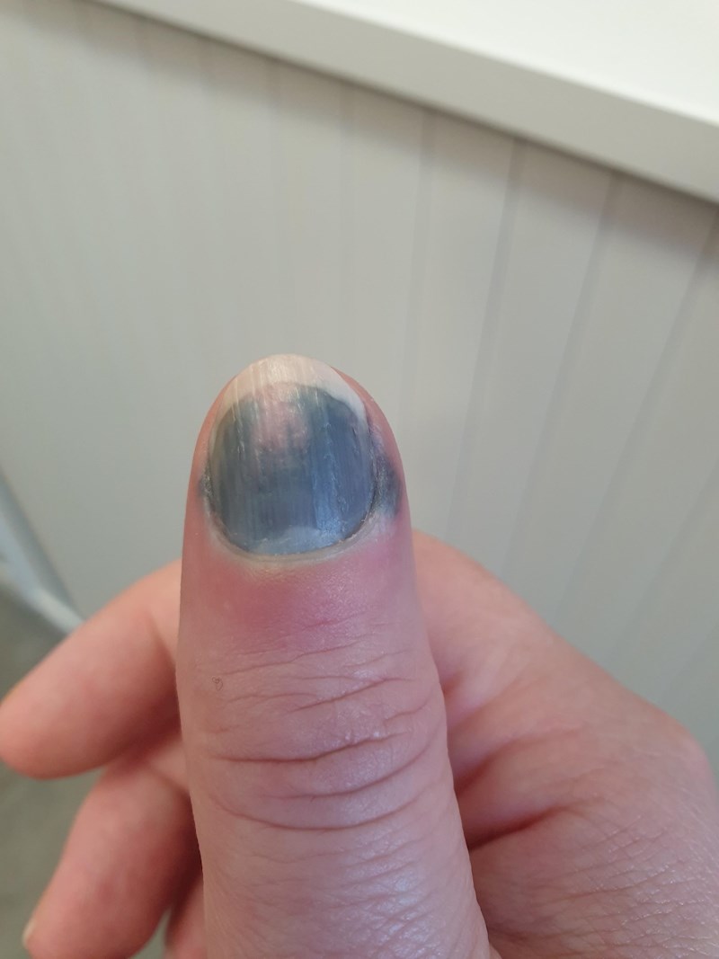 "Nisam pazila i zalupila sam vratima u palac. Ne veselim se onome što slijedi"