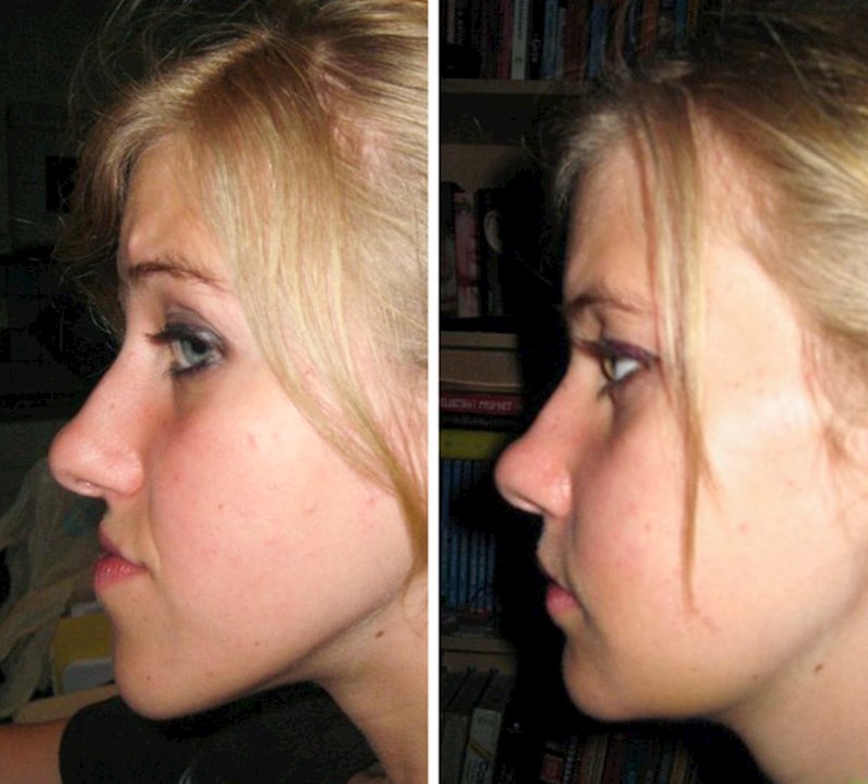 4. "Oduvijek sam bila nesigurna zbog svoje izbočene brade. Sada više nemam taj problem"