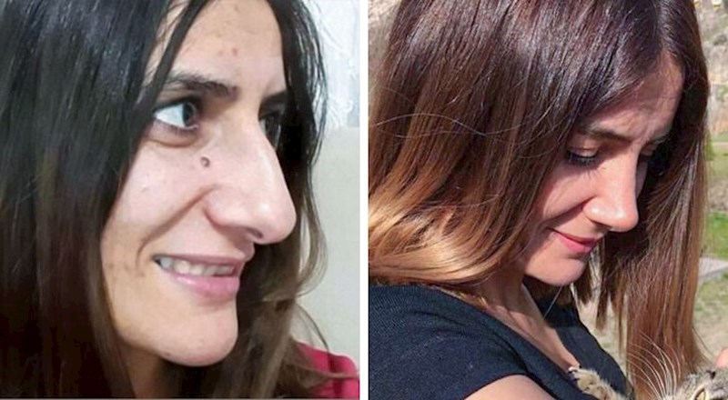 5. "Ne mogu vam opisati koliko sam sretnija otkad sam operirala nos. Imala sam problema s disanjem, a i mrzila sam kako izgledam zbog njega. Sad više nemam ni jedan od tih problema"