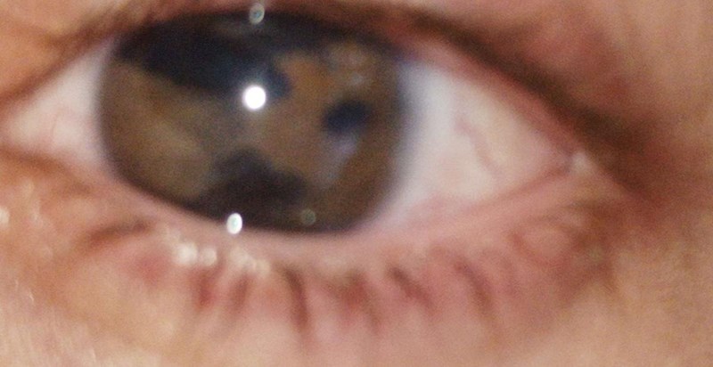 "Zbog Axenfeld-Riegerov sindroma imam tri zjenice u lijevom oku"