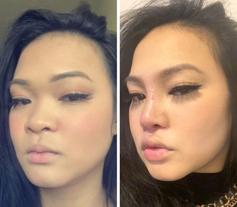 13. "Ovo sam ja 12 dana nakon operacije. Možda drugi ne vide toliku razliku, ali ja imam dojam kao da gledam drugu osobu"