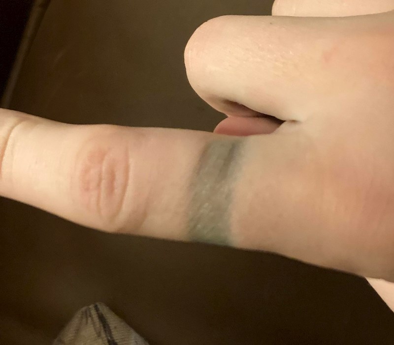 6. "Prvi put sam skinuo prsten nakon godinu dana. Šokirao sam se kad sam vidio kako mi izgleda prst"