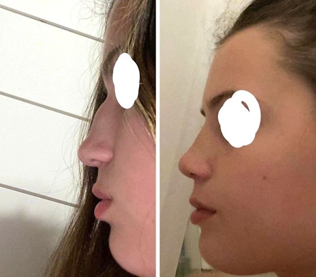 10. "Evo kako izgledam samo tjedan dana nakon nužne operacije nosa. Rezultati su nevjerojatni!"