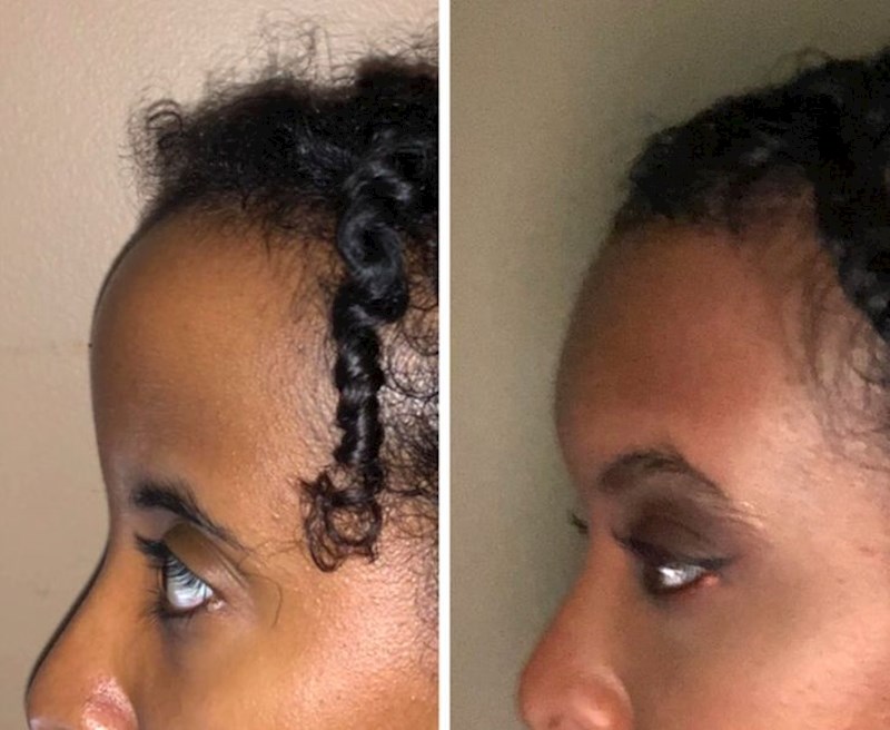 7. "Prošao je 61 dan otkad sam išla na operaciju smanjenja čela i podizanja obrva - vrijedi 100%"