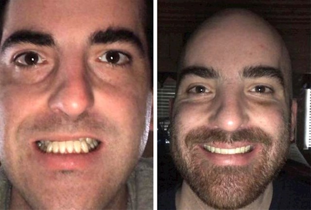 16. "Evo kako izgledam 10 mjeseci nakon operacije nosa i čeljusti. Jedino žalim što to nisam prije učinio"