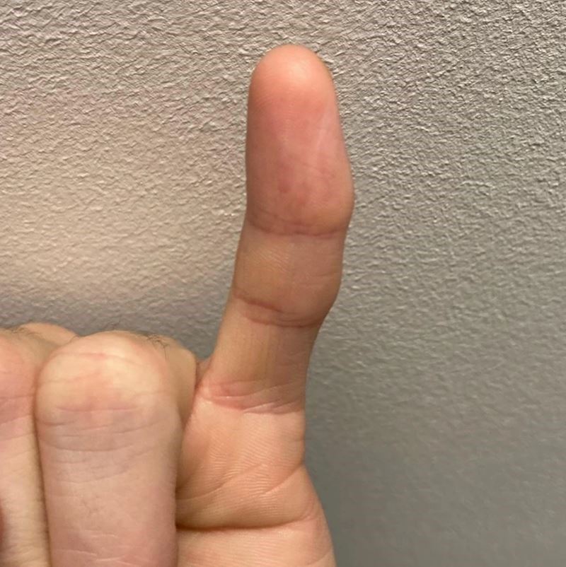 "Ne, moj prst nije slomljen, ali ovako izgleda otkad sam bio mali"