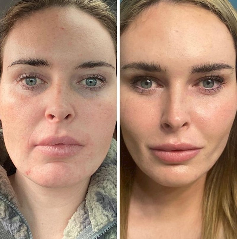 2. "Evo kako izgledam samo 10 dana nakon zahvata. Stvarno sam sretna!"