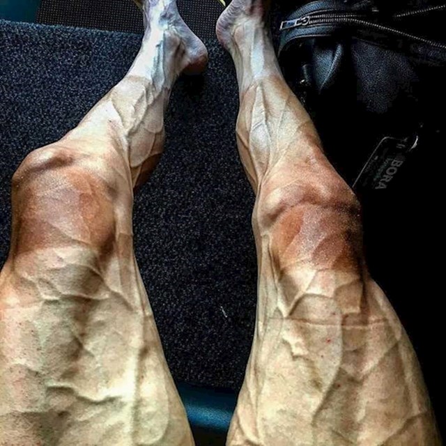 Ovo su noge biciklista nakon etape Tour de Francea