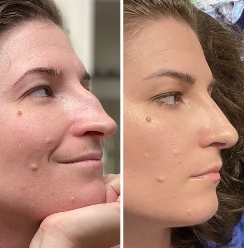 4. "Sedam tjedana nakon operacije nosa. Još uvijek postoje određena natečenja, ali već sam sada prezadovoljna rezultatima"