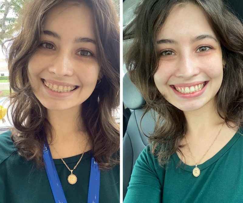 14. Kakav predivan osmijeh bez aparatića, vrijedilo je nositi ga nekoliko godina!