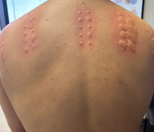 "Išao sam se testirati na alergije, ispada da sam na sve alergičan."
