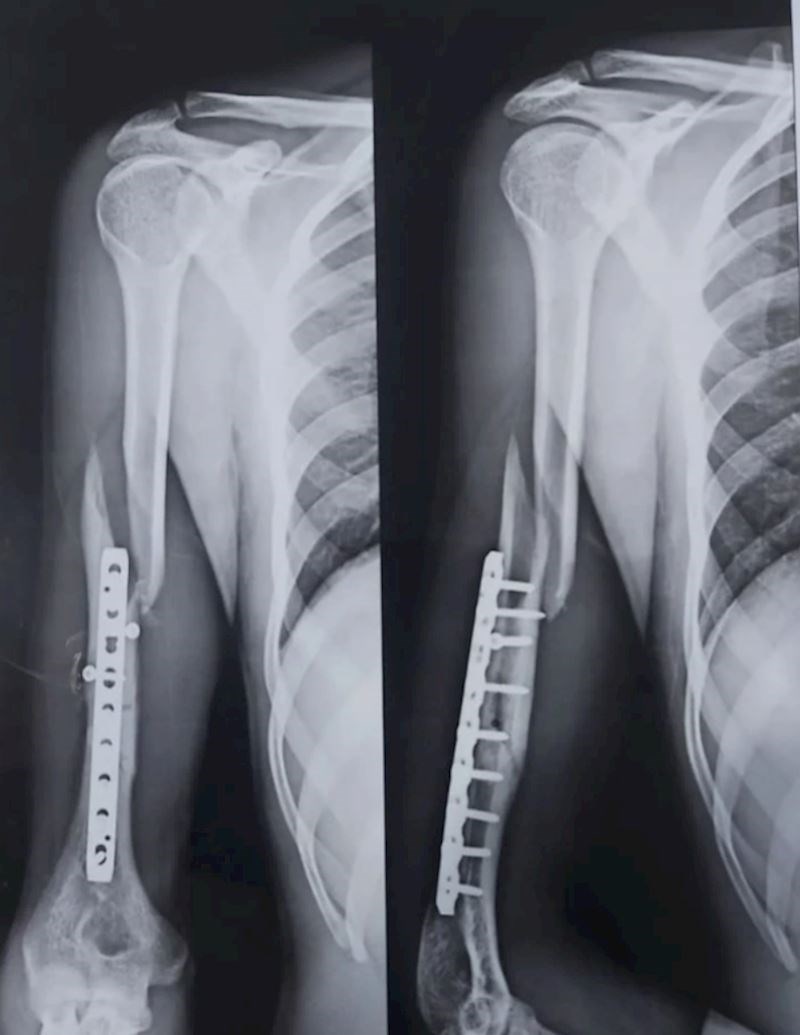 2. "Moj prijatelj je prije tri mjeseca slomio ruku na hrvanju, a onda ju je opet slomio na istom mjestu dok je igrao tenis."