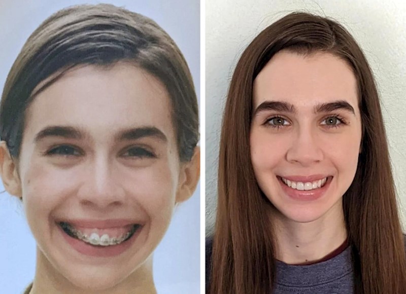 10. Kao djevojčica je bila nesigurna zbog svoje nepravilne čeljusti. Iako ni sada situacija nije "savršena", puno je zadovoljnija sobom