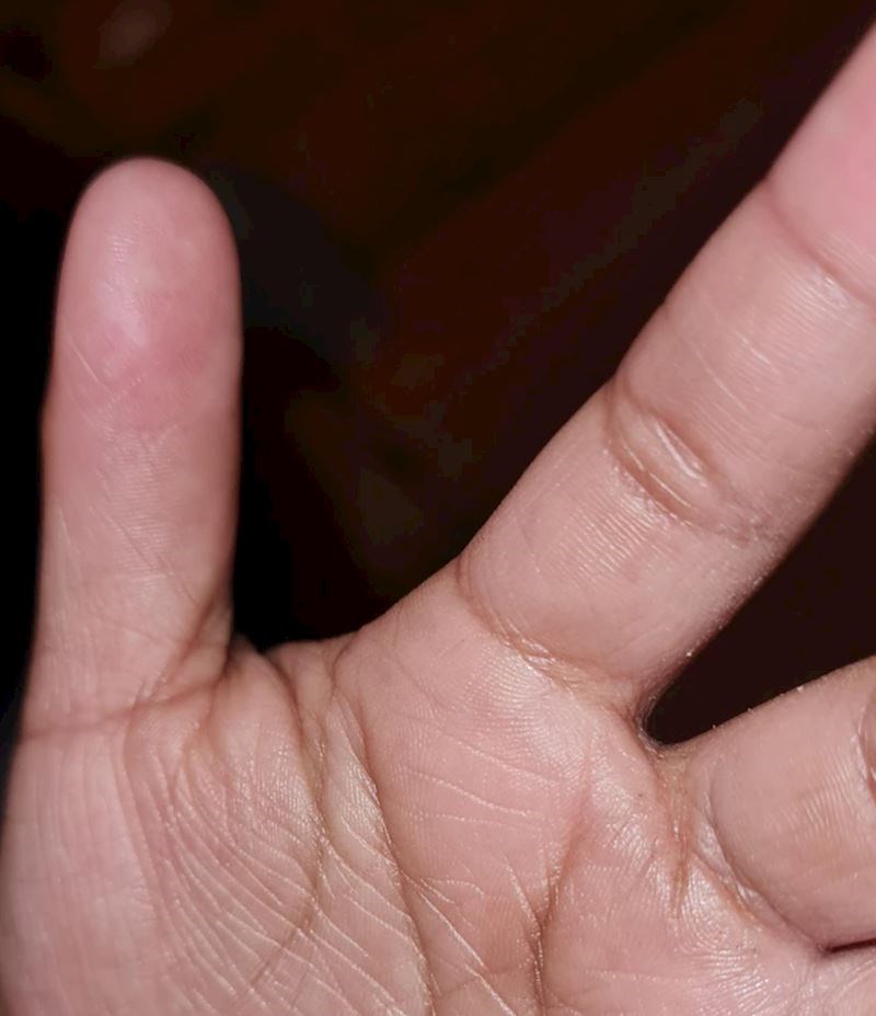 12. Moja nećakinja se rodila bez članaka na palcu"