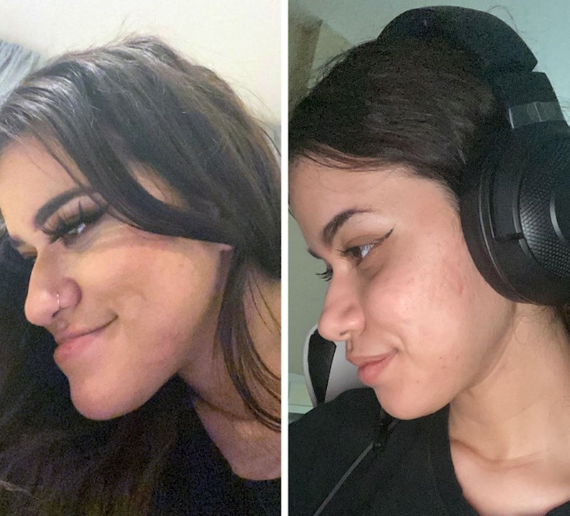 2. "Operacija brade je učinila čudo za moj izgled, ali i samopouzdanje"