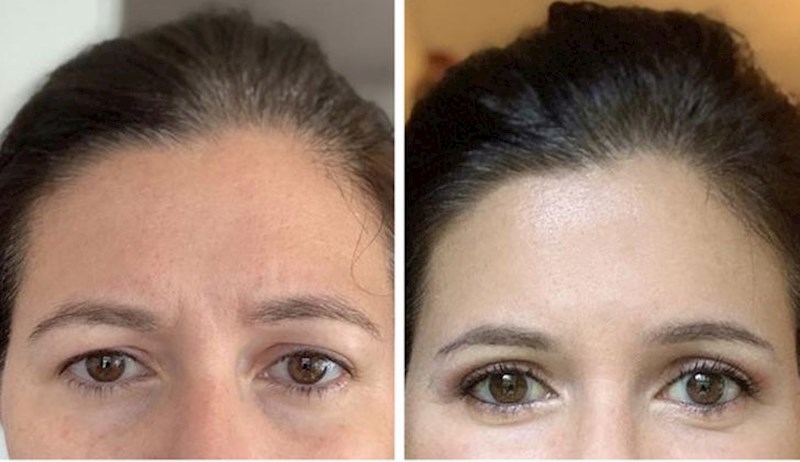 11. "Fotka prije i 11 dana nakon blefaroplastike, čini mi se da sada izgledam dosta mlađe"