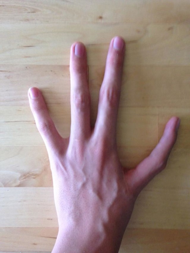 "Rođen sam s četiri prsta na lijevoj ruci. Umjesto palca imam kažiprst."