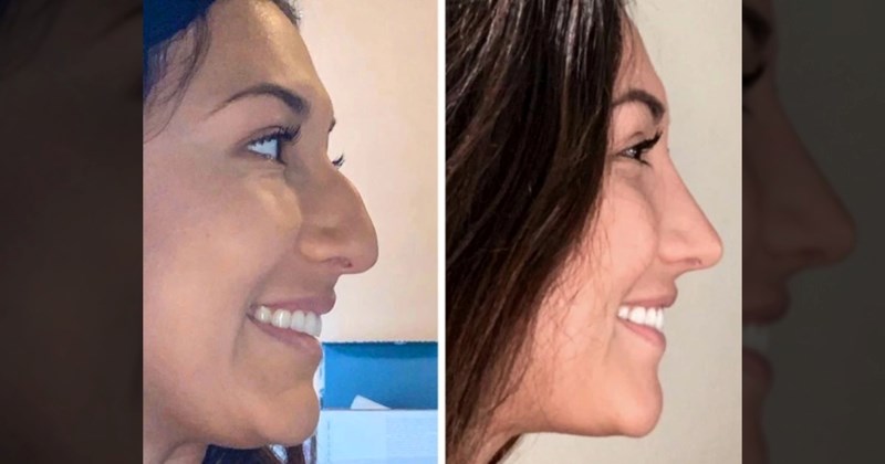 10+ ljudi kojima su se život i izgled drastično promijenili nakon plastične operacije