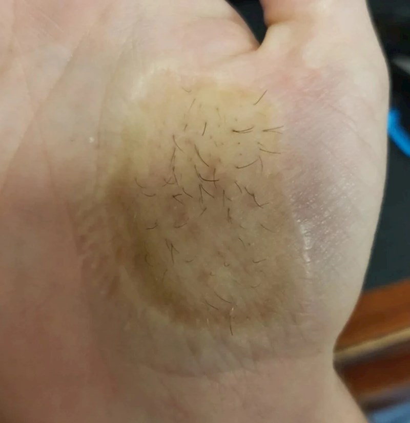 Čovjeku na ovom dijelu dlana rastu dlake