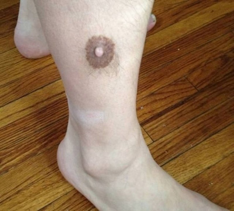 Ima bradavicu na nozi...