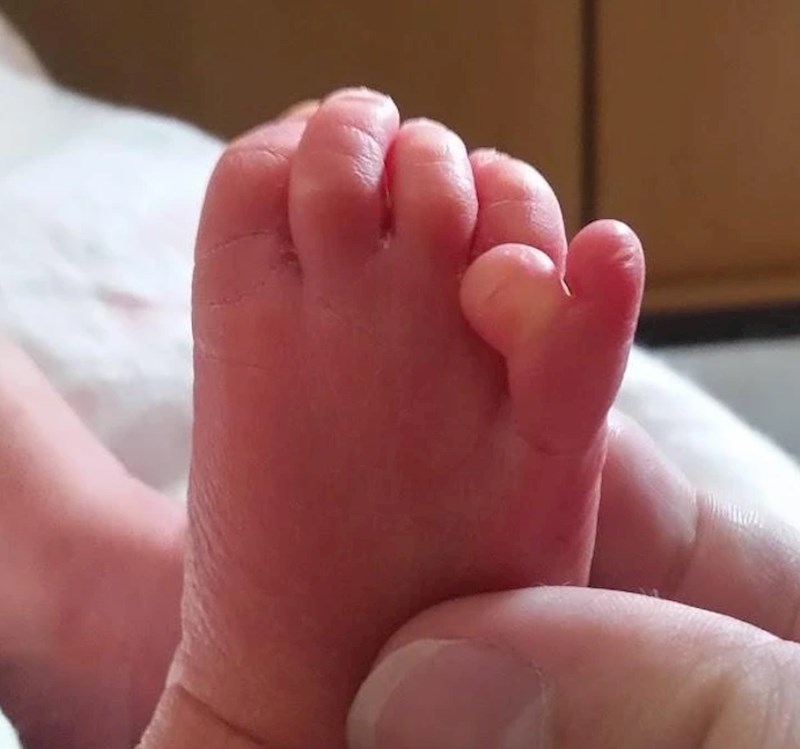 9. "Moj mališan se rodio s jednim dodatnim prstićem"