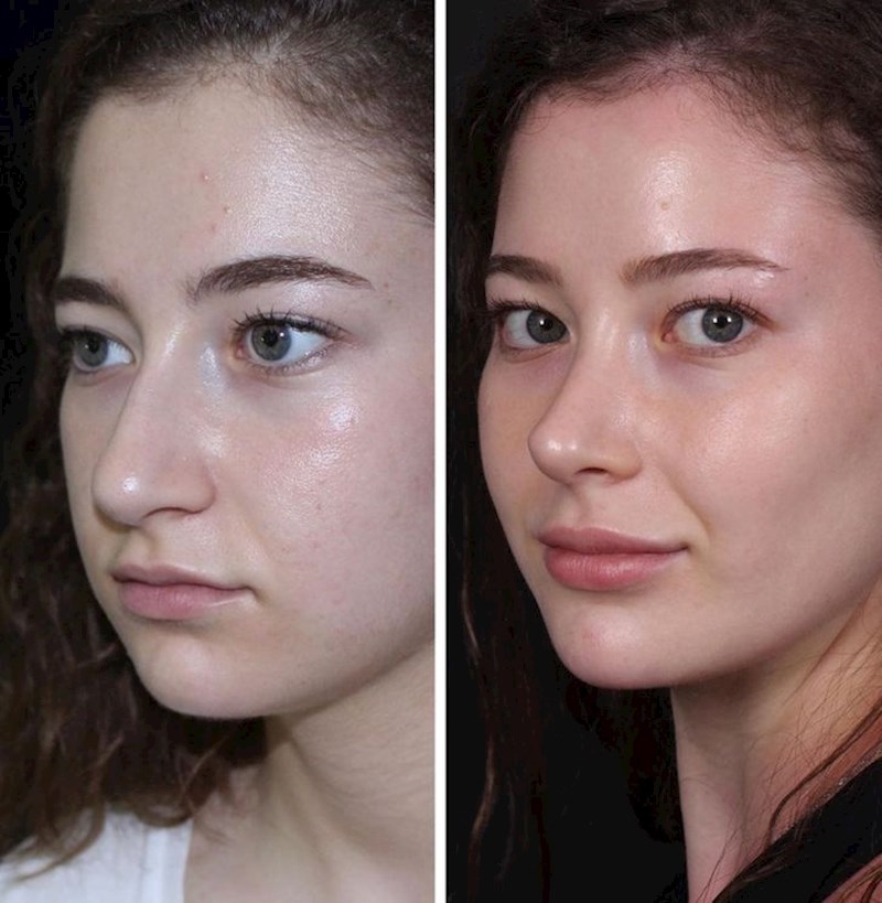 17. "Nedavno je bilo četiri godine od operacije. Najbolja odluka koju sam donijela za sebe"