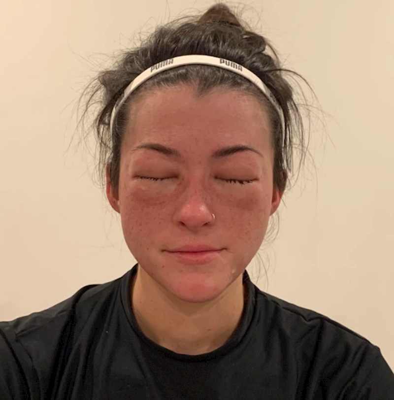 12. "Otkrila sam da sam alergična na banane."