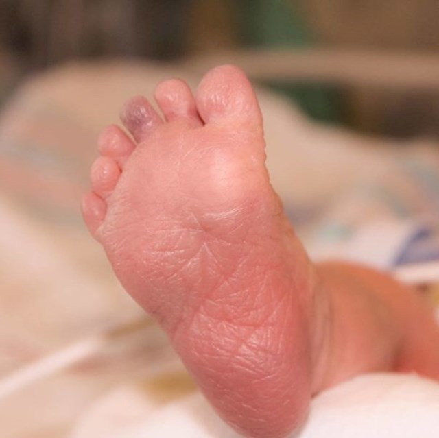Ova beba je rođena s prstom viška na svakoj nozi.