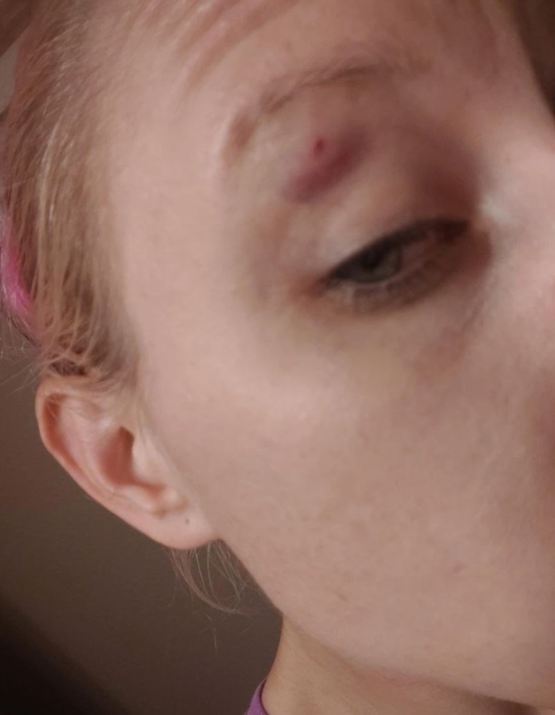 "Jako sam plesala dok sam radila i u jednom trenu toliko zamahnula glavom da sam udarila u laptop. Sad mi je natečeno oko."