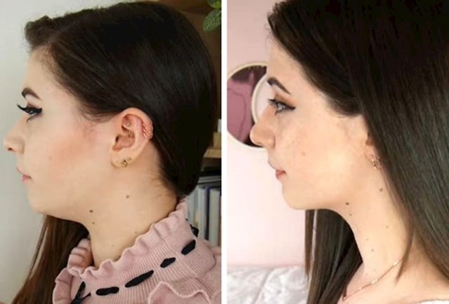 14. "Fotka prije i poslije operacije brade"